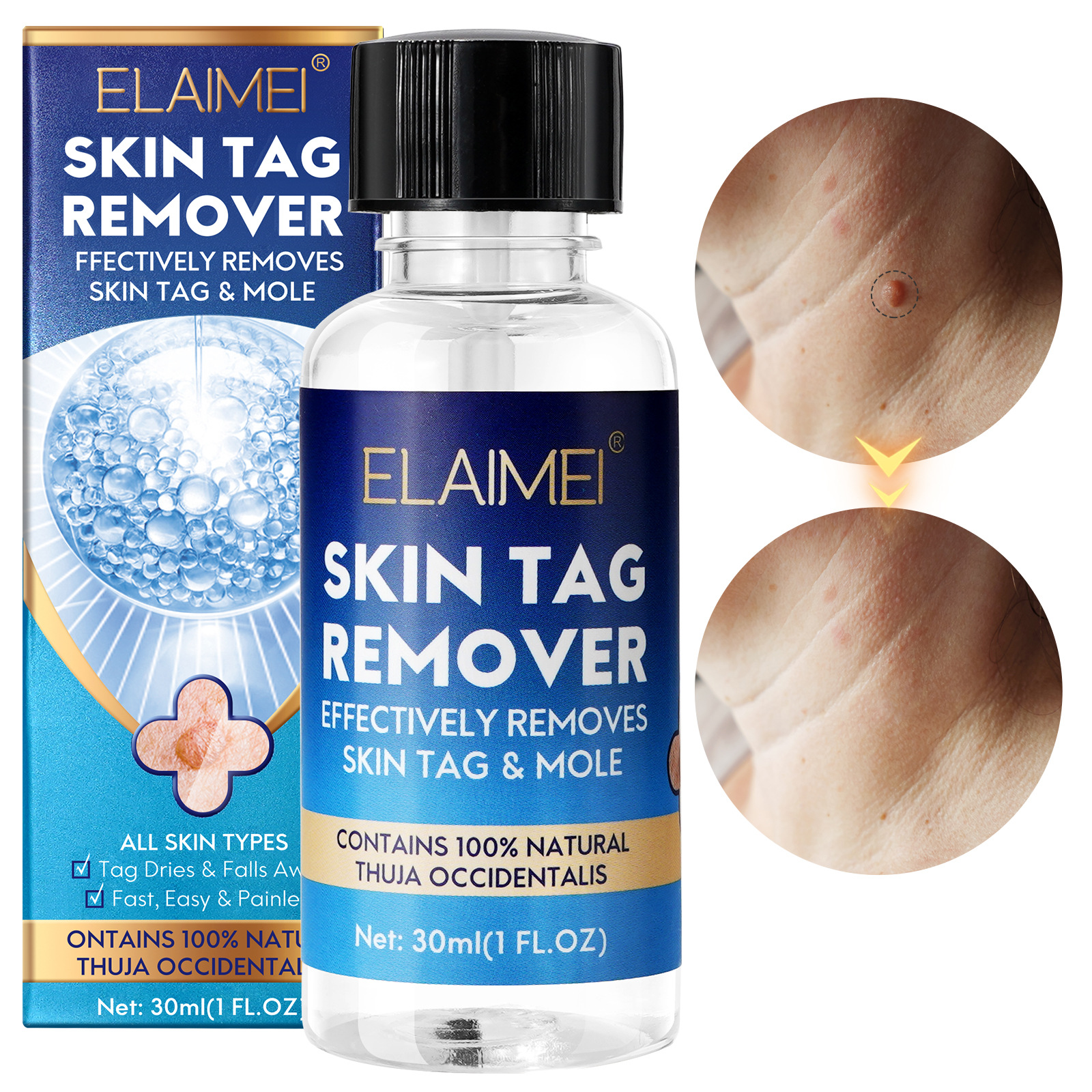 跨境elaimei祛疣溶液瓶装克疣祛疣祛鸡眼肉粒肉刺扁平瘊尖锐丝尤