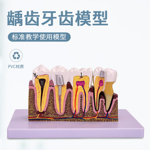 牙科口腔四倍龋齿分解模型 牙齿蛀牙演示龋齿发展病理 医患沟通