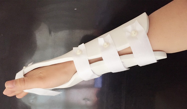 高分子挠骨骨折夹板手腕扭伤固定支具骨裂护腕后石膏前臂三角固定