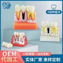 种植牙 4倍种植解模型 义齿修复种植牙解说 可拆卸 连桥牙冠 种