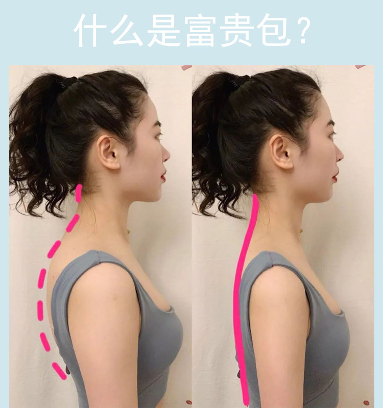 久木堂颈肩富贵包消膏颈部大椎鼓包僵硬疏通颈椎膏贴oem一件代发