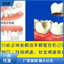 假牙胶水自己动手粘烤瓷牙胶水固定牙套牙冠全瓷专用胶水保证