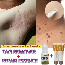 Skin Tag Remover Bacteriostatic Liquid 10 ml Medical Genital