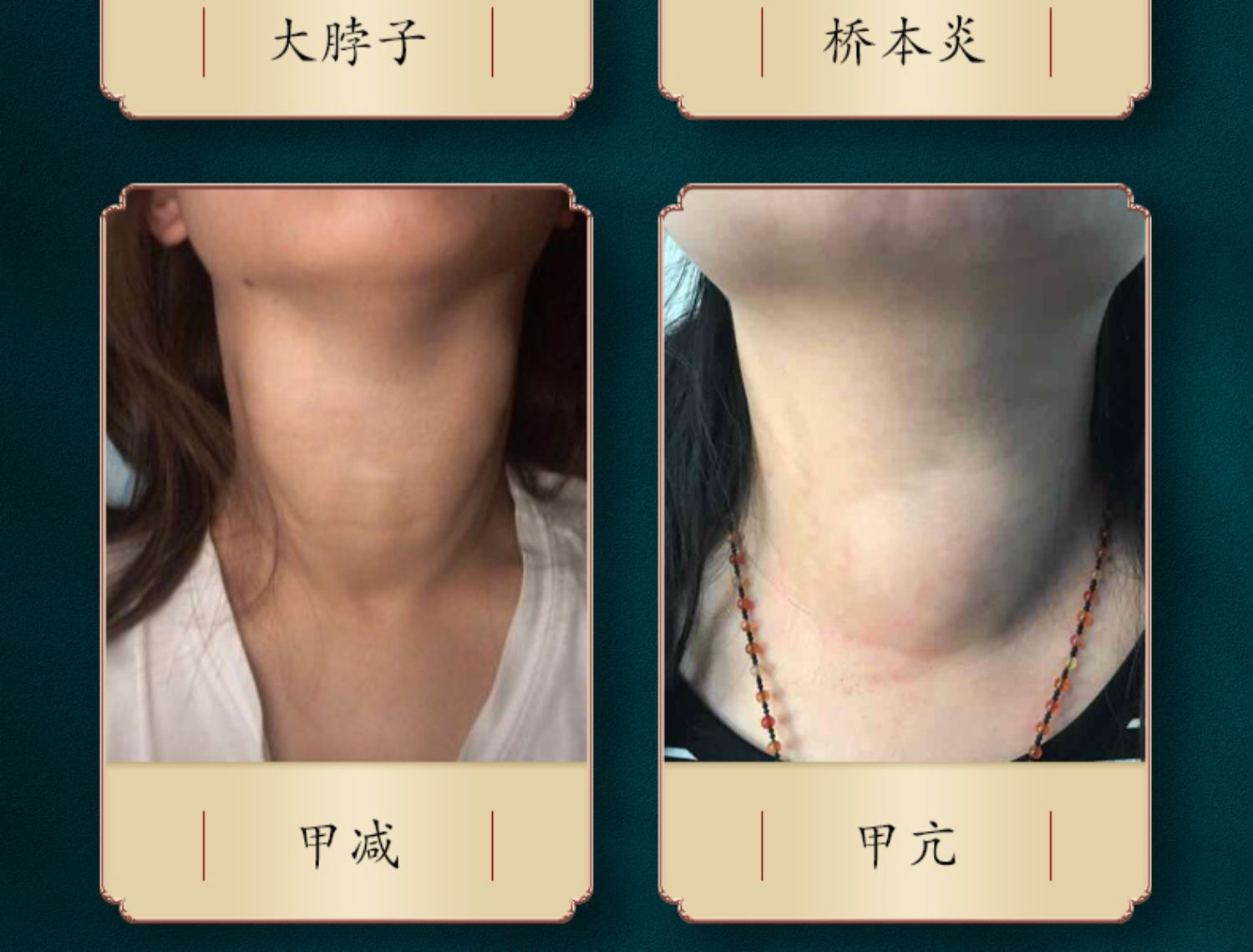 李时珍甲状腺贴甲状腺结节散结贴脖子肿大脖子痛粗桥本甲状腺贴