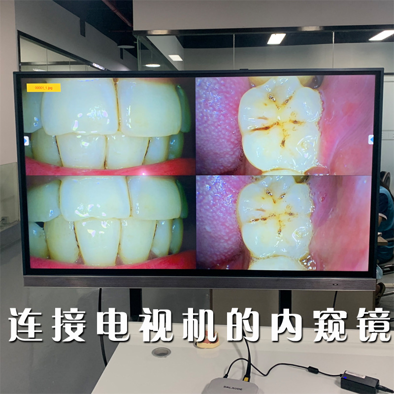 连接电视机电脑显示屏口腔内窥镜牙科拍照高清wifi手机传输图片
