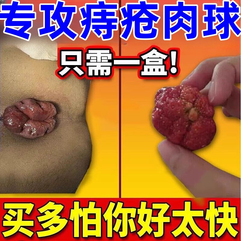 痔疮特效云南本草药华佗断痔膏内外混合痔去肉球痣苍膏痔根断正品