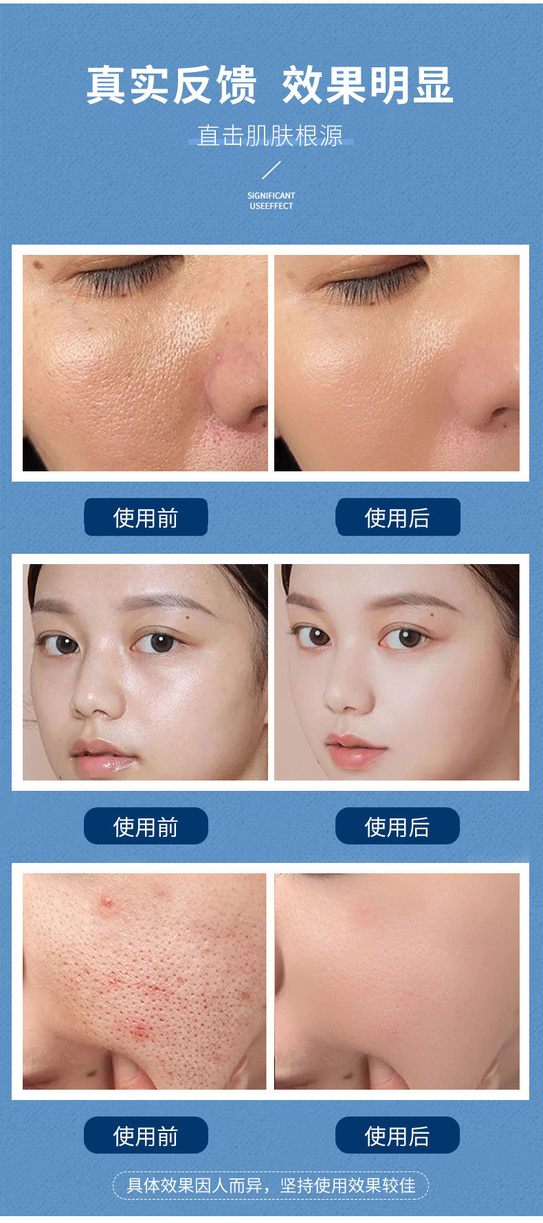 芙诗婷小气泡寡肽面膜补水保湿清洁毛孔去黑头面膜睡眠涂抹式正品