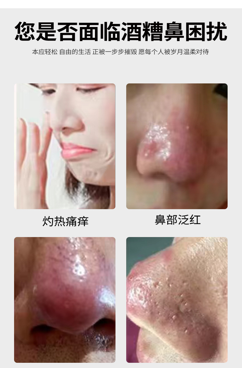 去黑头红肿红血丝草莓鼻酒渣鼻膏 修复粉刺露红鼻子酒糟鼻专用膏