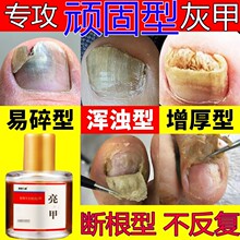 脚指甲增厚变黄灰甲神器脚趾甲变厚发黄变硬黄指甲盖坏甲变好甲药