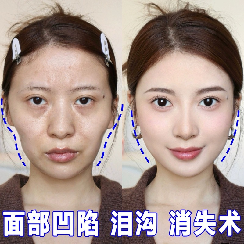 面部丰盈精华液丰太阳穴泪沟凹陷泪沟法令纹抬头纹填充脸颊眼窝