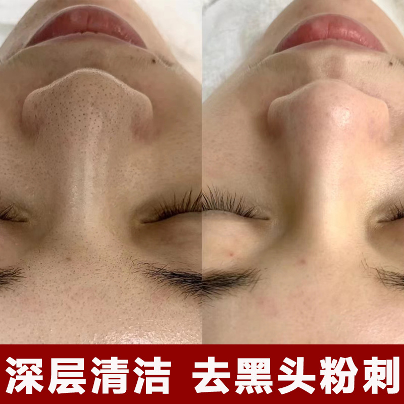 毛孔清洁霜面部清洁毛孔去黑头粉刺角质除螨控油美容院毛囊清洁膏