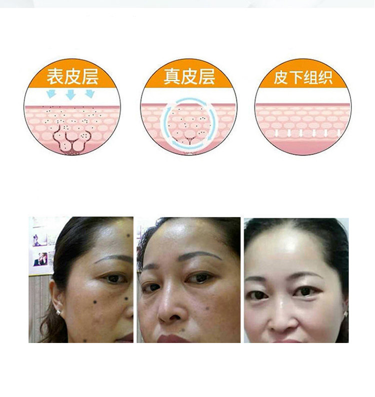 佰草世家玫瑰精油无痕无痛去脸上黑点斑点提亮肤色男女正品