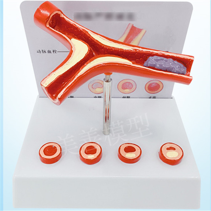 ld blocked blood vessel blood concentration fat pathology blood atherosclerosis human vascular pathological anatomy model