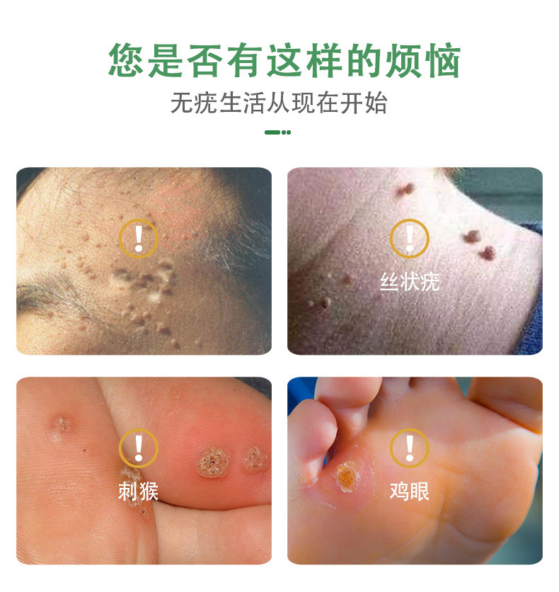 瘊尤平鸡眼肉刺猴寻常尤瘊灵跖尤老茧脚茧皮肤外用软膏跨境鸡眼膏