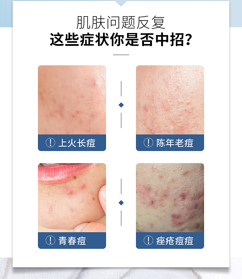 比芭美壬二酸祛痘霜 壬二酸凝露凝胶软膏乳膏祛痘刷去黑头粉刺酸