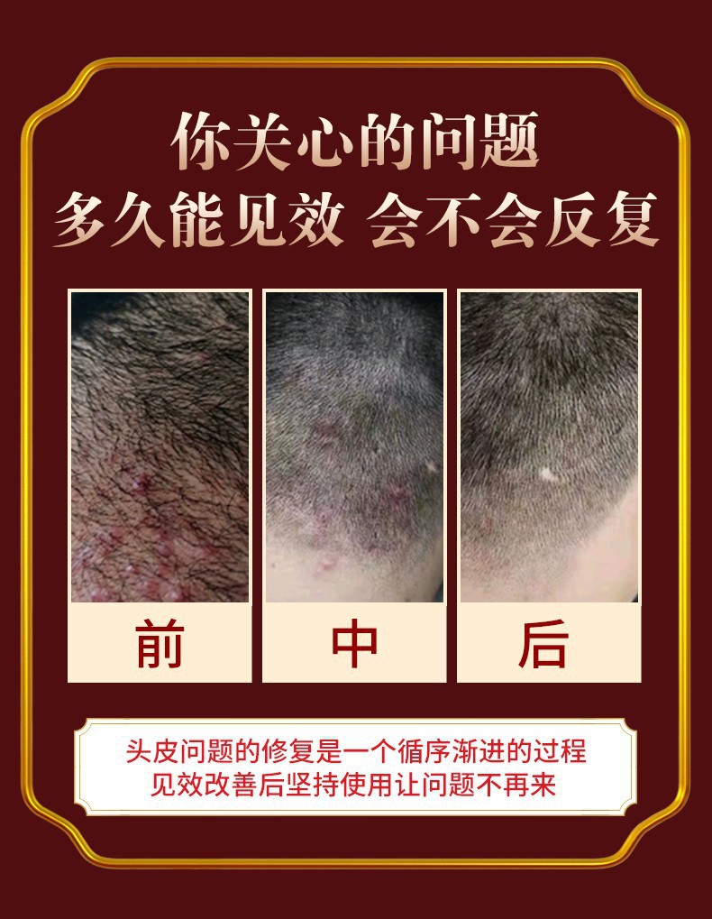 南京同仁堂毛炎宁洗发水去屑止痒控油除螨疙瘩头皮癣氨基酸洗发水