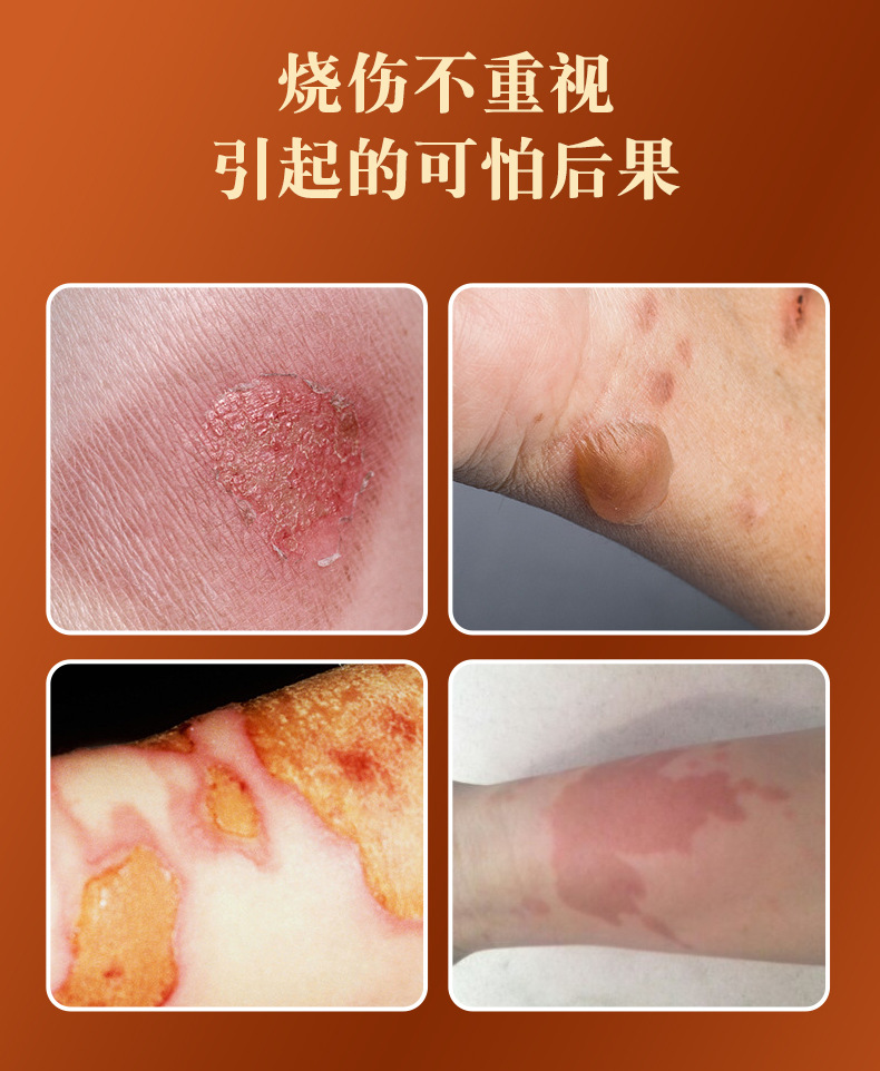 烧烫伤膏草本抑菌膏紫草膏开水烫伤膏烧伤膏皮肤外用软膏身体护理