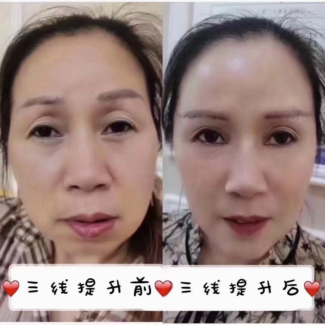 Top Trend Beauty Clinic | Profhilo紧致提升针