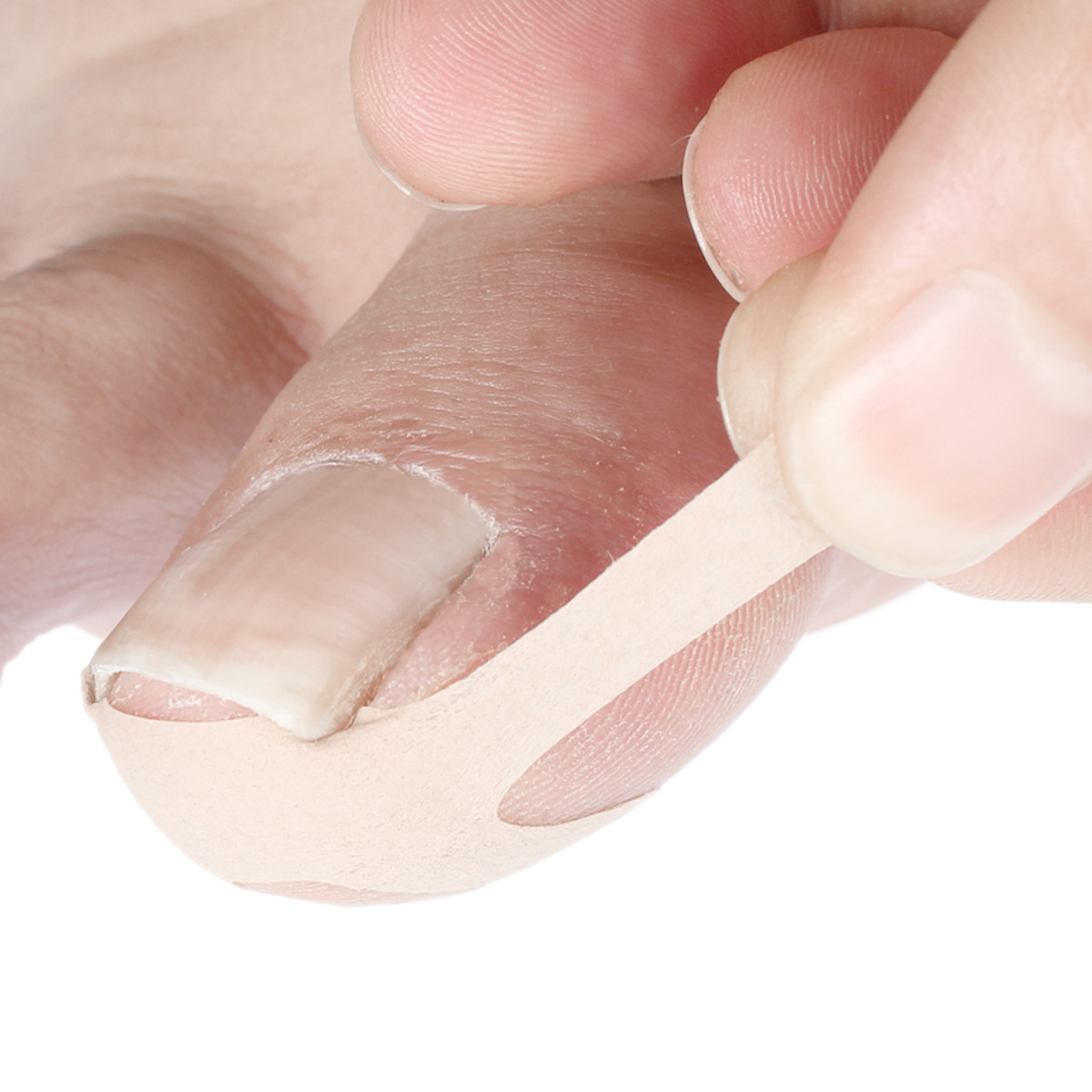 嵌甲贴 一次性甲沟纠正贴脚趾甲趾甲矫正趾甲往肉里长甲肉分离贴