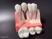 口腔牙模型 4倍种植解说模型 牙冠可拆卸种植钉展示模型 医患沟通