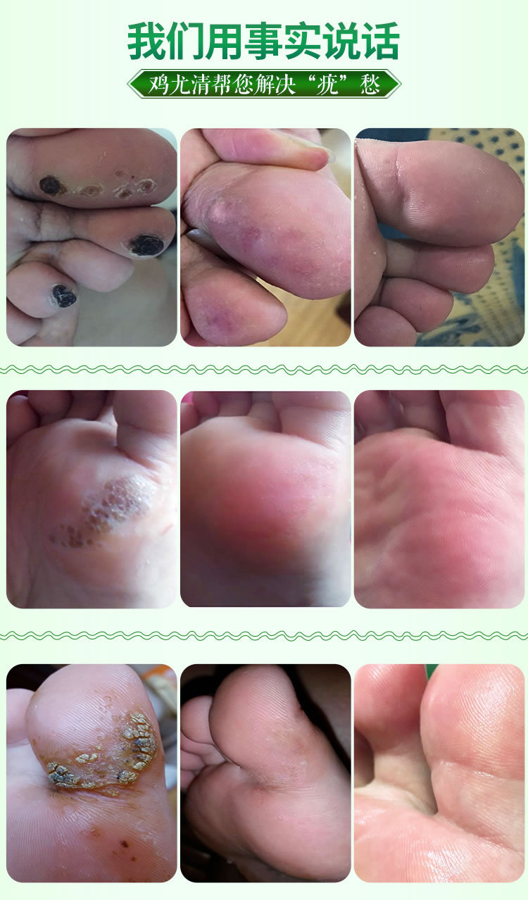 仁和鸡眼膏疣瘊子净贴根祛去除刺猴鸡眼趾灵足部正品肉刺老茧
