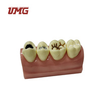 UM-F17牙齿模型口腔模型 医患沟通教学演示模型窝沟封闭示范模型