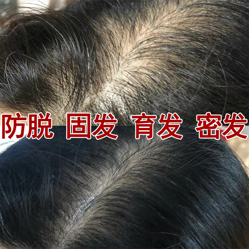 防护脱育发液生长发液增多发液白转黑精华液白发转黑发头发生长液