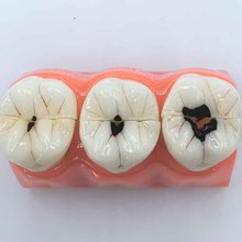 牙科口腔教学模型四倍龋齿分解模型医患沟通示教牙齿模型