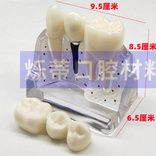 牙科种植模型桥冠学习教学分解模型 医患沟通牙模4倍比例展示牙模