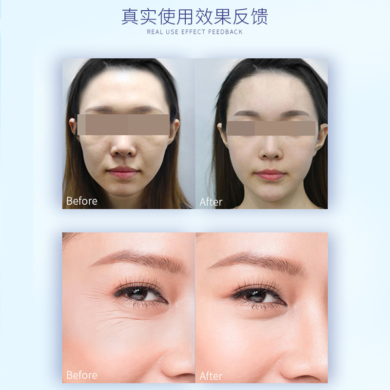 3d童颜针plla聚左旋乳酸冻干粉面部凹陷填充不回落法令纹泪沟工厂