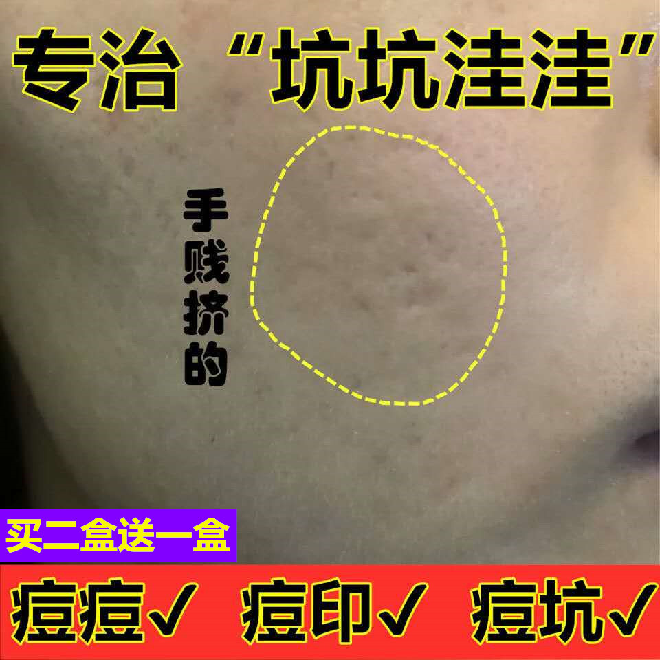 包邮祛痘印痘坑痘疤凹洞填充去痘坑修复男士女细胞再生微针去复平