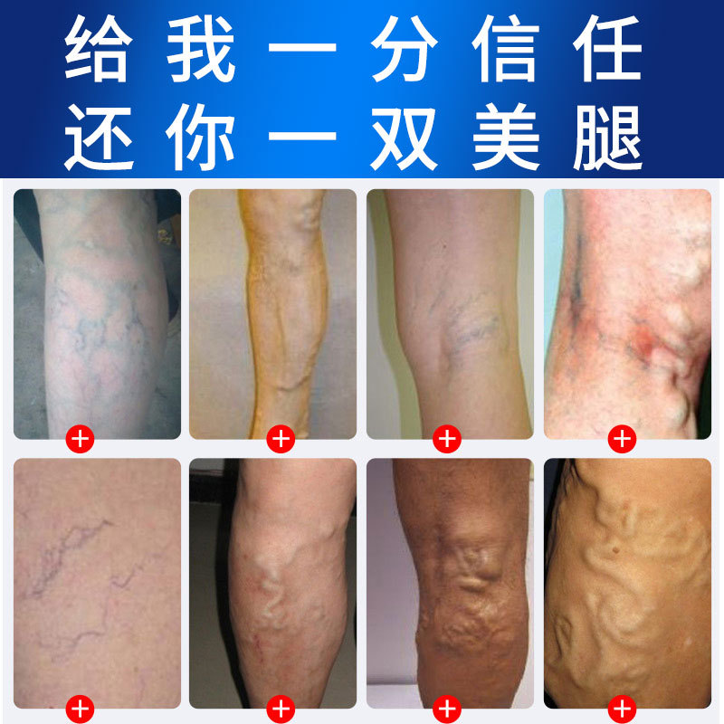 静脉贴膏冷敷非凝胶老黑膏曲张私处护理腿部静动脉无纺布贴喷剂金