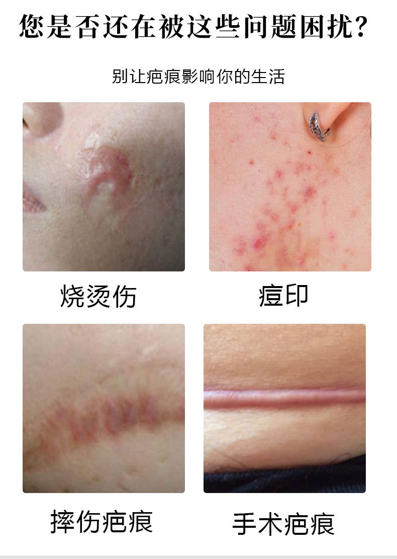 修复烧伤烫伤摔伤疤痕 脸部痘印手术增生疤痕等外伤专用疤痕软膏