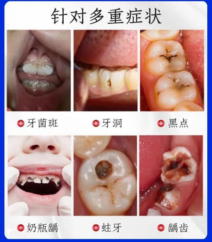 分类买3送2【五盒疗程使用】牙缝小洞,买4送3【修复龋齿】愈合牙洞,买