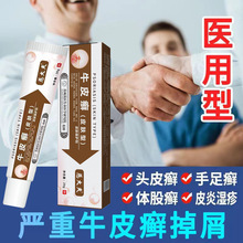 头癣药膏治头部头癣银屑癣真菌感染头皮屑脂溢性皮炎头皮癣药膏wl