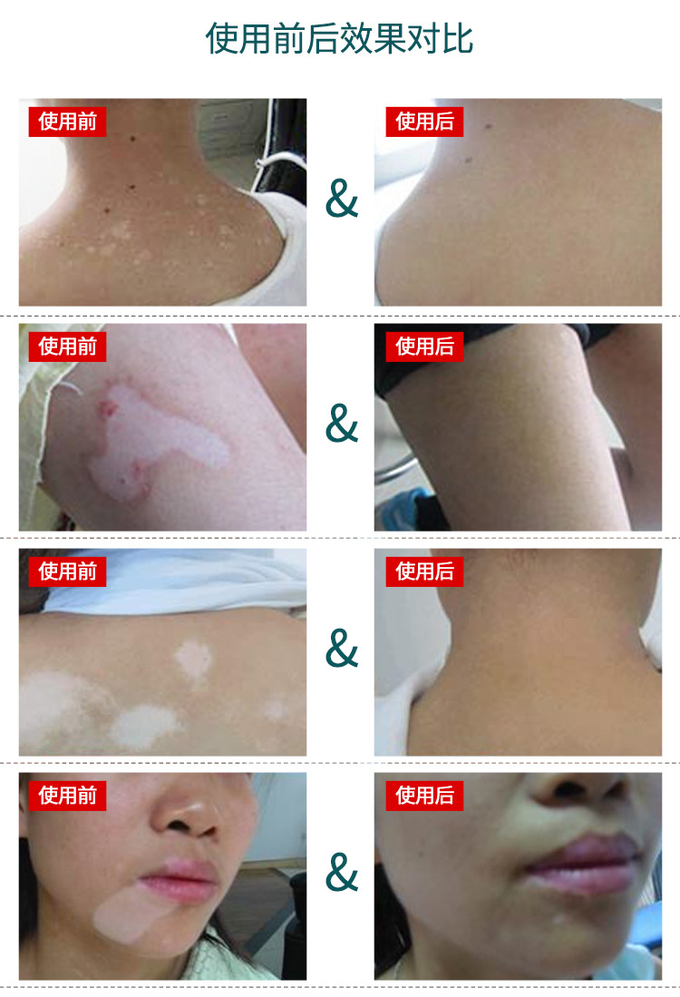 厂家直供欣佰沐康白斑抑菌液补骨脂白斑花斑汗斑白癜批发促黑色素