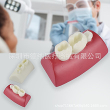 牙科练习树脂块儿练习补牙根管填充 补牙练习 根管补牙模型 嵌体