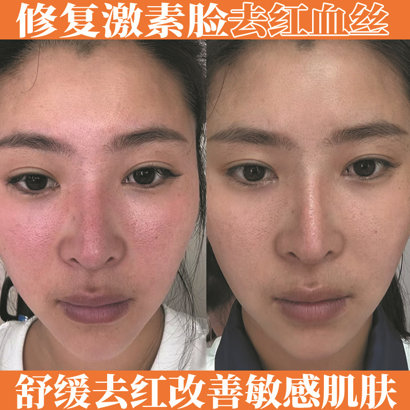 美容院专供激素脸修复霜去红血丝增厚角质层退红退敏保湿修复面霜