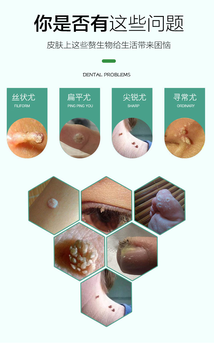 厂家直销克疣膏克疣液皮肤外用软膏丝状瘊疣平抑菌膏非鸡眼膏