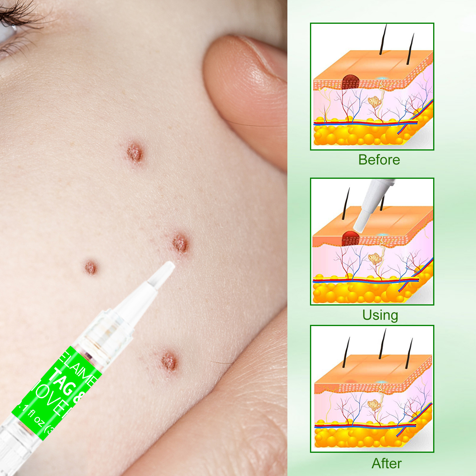 elaimei 疣子笔瘊疣笔净光祛赘生物克疣液笔跖疣含笔套装祛疣贴