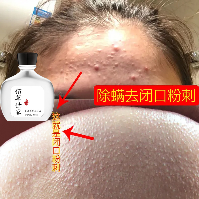 8成交20瓶佰草世家粉刺露控油祛痘去粉刺除螨爽肤水男女学生去黑头