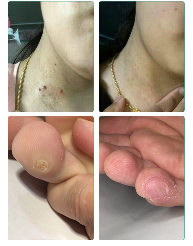 力克宁鸦胆子跖疣膏疣瘊子猴子净刺猴鸡眼趾正品肉粒疙瘩尤肉刺