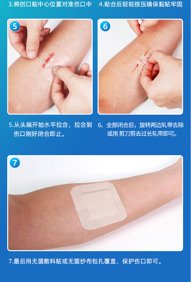 拉链式缝合器减张贴伤口家用免缝合贴皮肤减张器吻合器拉合贴固定