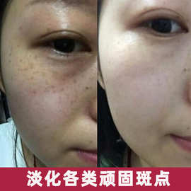 欧莱雅祛斑美白套装_欧莱雅美白祛斑系列_祛斑美白小妙招,快速祛斑美白