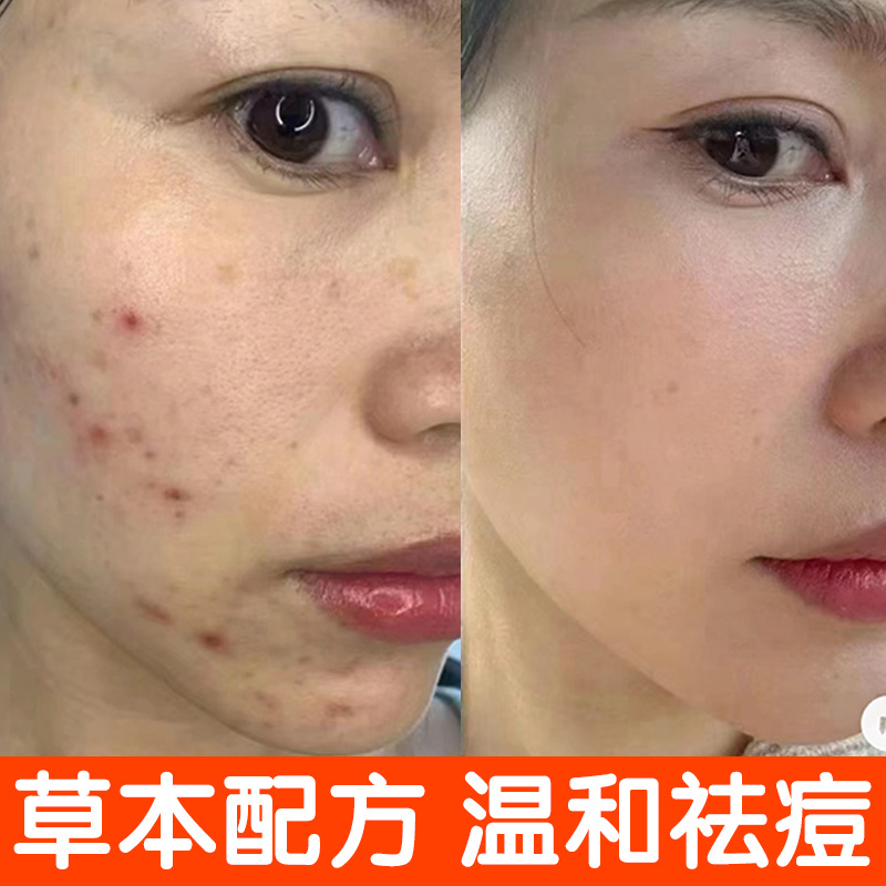 祛痘膏去粉刺闭口痤疮青春痘修复痘坑痘印控油草本植物美容院批发