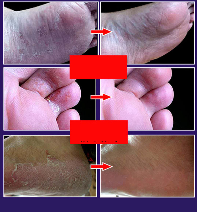 滇同堂狼毒真菌王除脚足部护理脚爽脚臭脚痒喷脚止痒抑菌狼毒喷剂