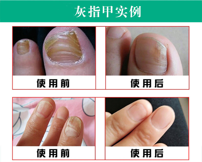 新亮甲抑菌型灰指甲药亮甲新套装批发亮甲抑菌剂套装可oem代发