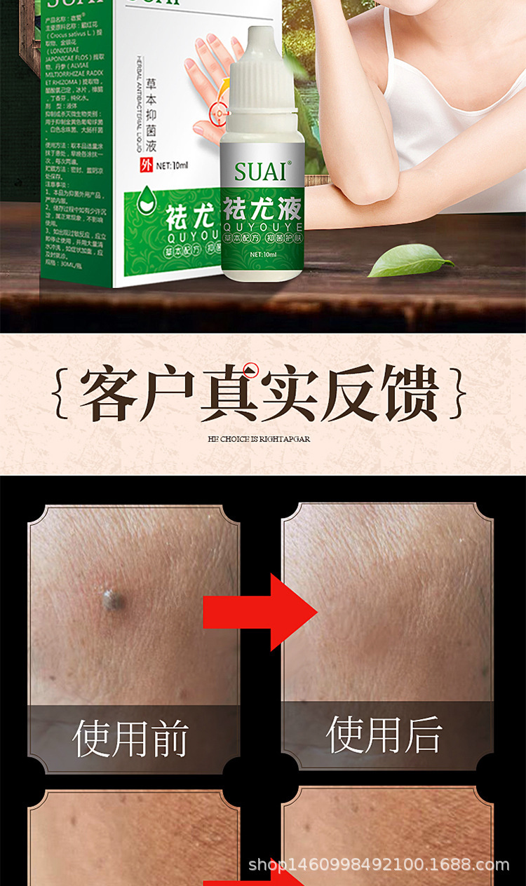 【官方】宿爱祛尤液去除平疣丝状疣10ml厂家直销 oem贴牌代加工