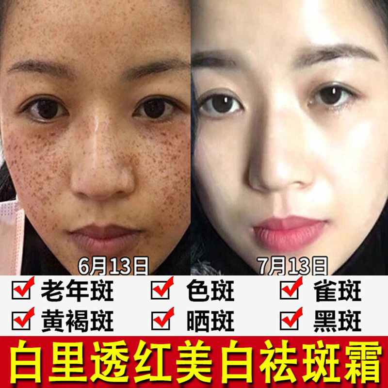 黄芪去斑霜化斑霜去黄褐斑雀斑老年斑白里透红强效拉丝祛斑霜批发