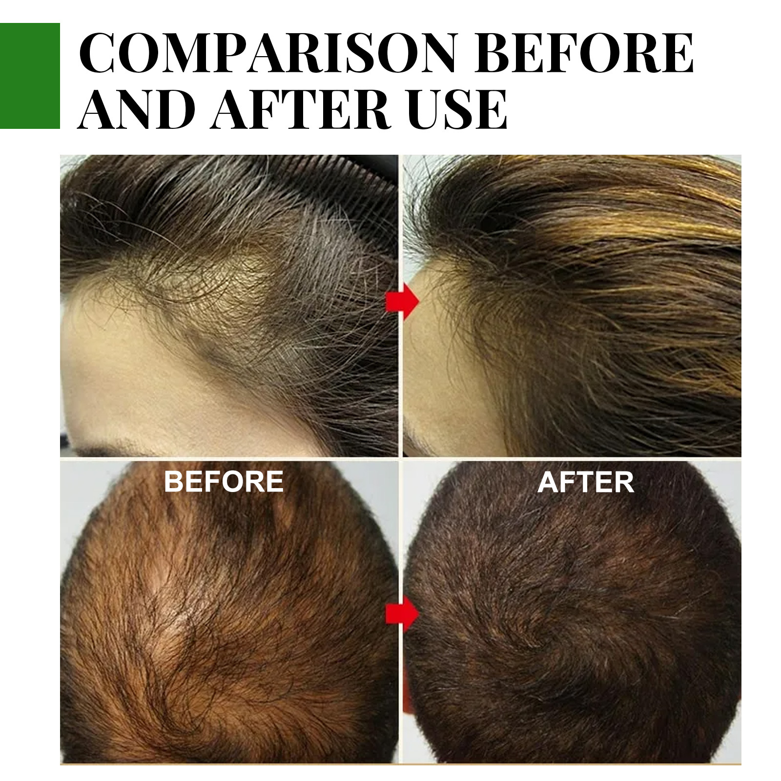 Eelhoe Rosemary Hair Care Essential Oil Anti-Broken Hair Hair Dense Hair Essential Oil Anti-Hair Care Scalp Essential Oil